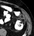 Epiploik appendajit