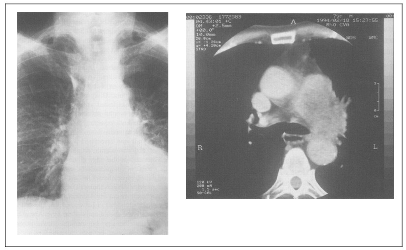 TANISAL ÇALIġMALAR Rutin akciğer filmi (PA ve lateral) en yaygın kullanılan radyolojik görüntüleme yöntemidir.