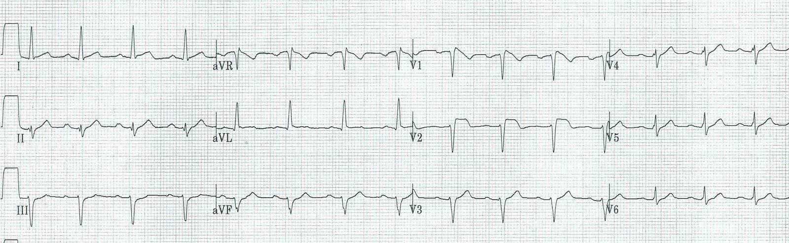 Hiperbarik merkezdeki EKG V1 de downslopping
