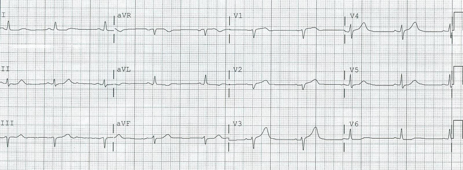 EKG 19:13