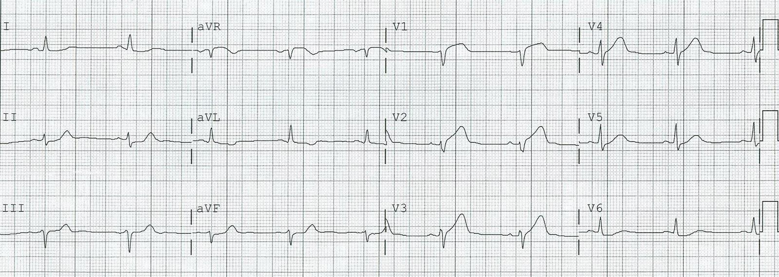 EKG 19:20