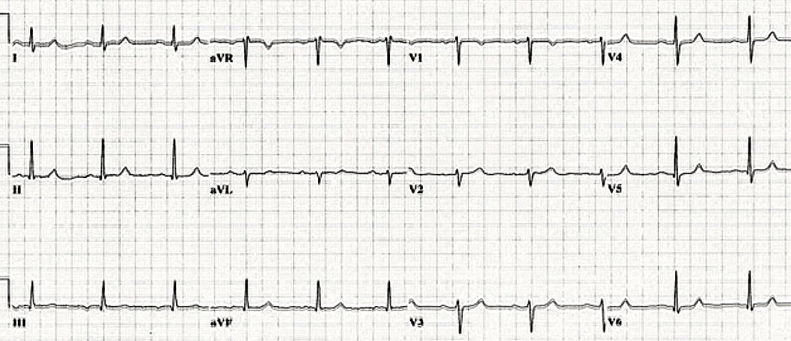 V1 de yeni yüksek T dalgası (prekordiyal T dalga dengesinin kaybolması) Normal EKG de V1 in T dalgası