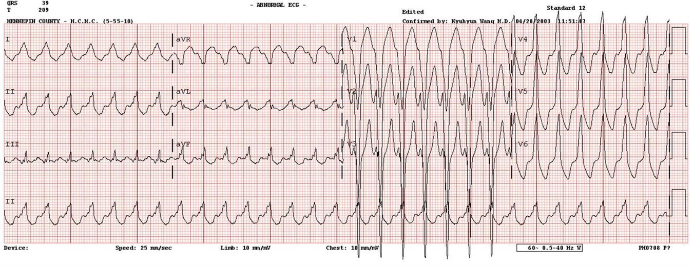 Vaka 9 Cevap Ayırıcı tanılar?? Düzenli geniş QRS kompleks taşikardi (EKG 1): 1. Ventriküler taşikardi, 2.