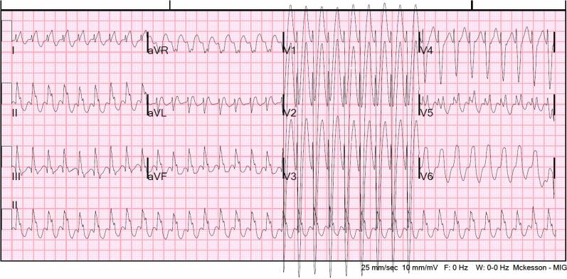 Değerlendirme.. VT-SVT ayrımı 1. Her QRS öncesi p dalgası var mı? SVT 2. EKG nin herhangi bir yerinde dar QRS den genişe geçiş bölgesi var mı? SVT 3. QRS süresi: VT de en az 140 ms olmalıdır.