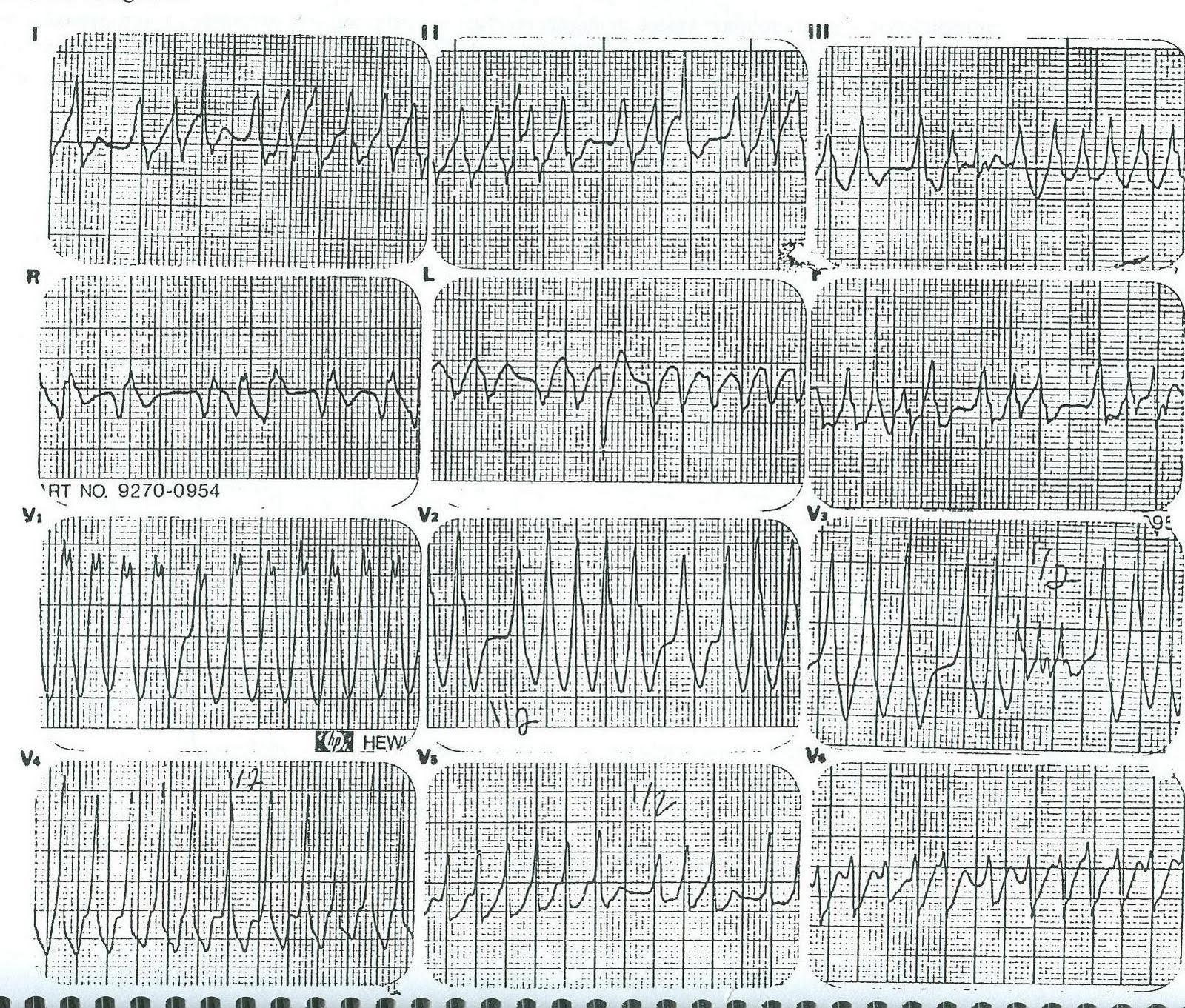 EKG İrregüler Geniş QRS Multiple