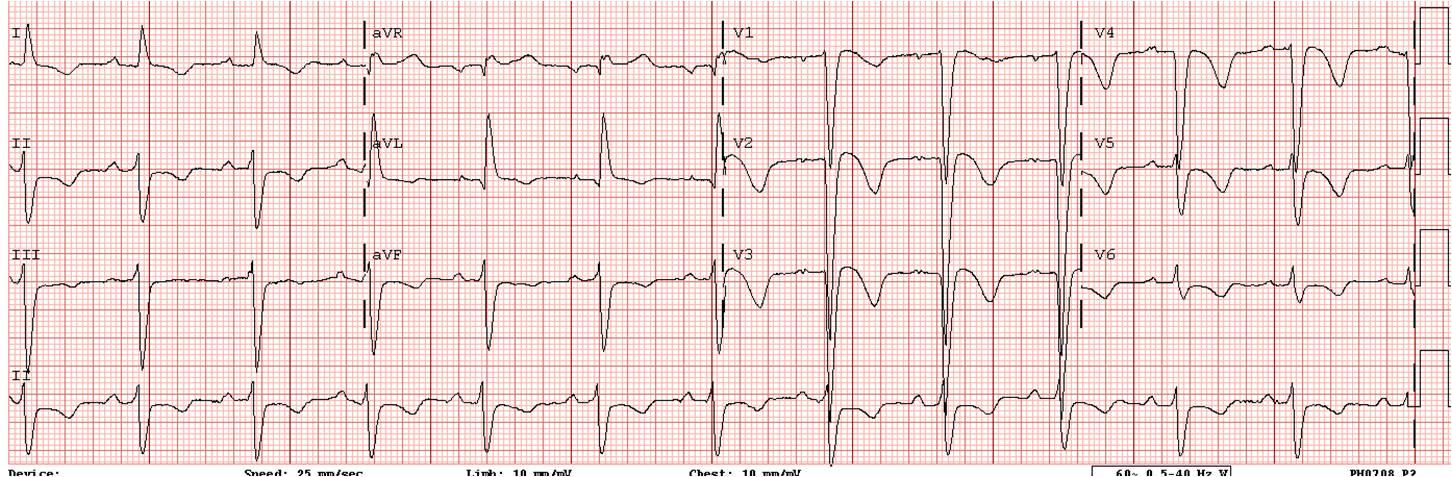 Hasta sonuçlanım KAG %100 LAD tıkalı Açıldı sonrasında EKG si ST segment elevasyonu düzeldi.