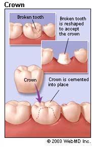 Dental Kaplamalarda Görülen Hasarlar / İnceleme Aşaması