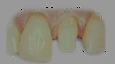 Dental Kaplamalarda Görülen Hasarlar / İnceleme Aşaması 2-İNCELEME TOPLANTILARI (Beyin Fırtınası) Karar: Tek diş üzerine kaplama modeli oluşturulacak, aynı soğuma ortamı (hızı) için, piyasada