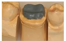 Dental Kaplamalarda Görülen Hasarlar / İnceleme Aşaması 1-İNCELEME FAALİYETLERİ Kaplama Hazırlanış Aşamaları 3- Alçı Modelin Eksik Diş Bölgeleri Mum malzeme ile diğer dişlere uygun şekilde doldurulur.