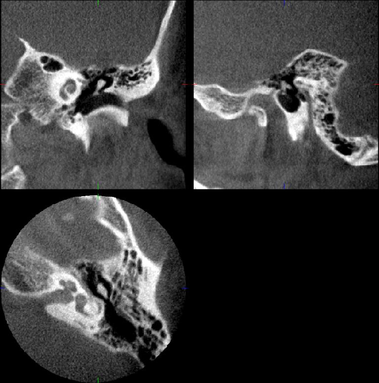 Zoom Reconstruction (Zumlayarak yeniden oluşturma) Bu fonksiyon ile daha önceden çekilen ve daha büyük voxel ölçekli bir DVT görüntüsünün istenilen bölgesinden yüksek çözünürlükte 80 mikrometre voxel