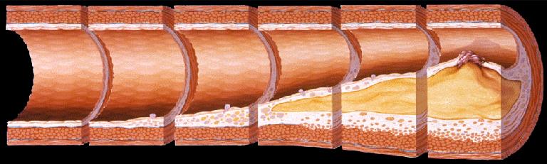 Ateroskleroz Gelişimi Köpük hücreleri Yağlı Orta dereceli çizgilenme lezyon Aterom