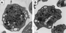 Paris-Trousseau (Jacobsen) syndrome.