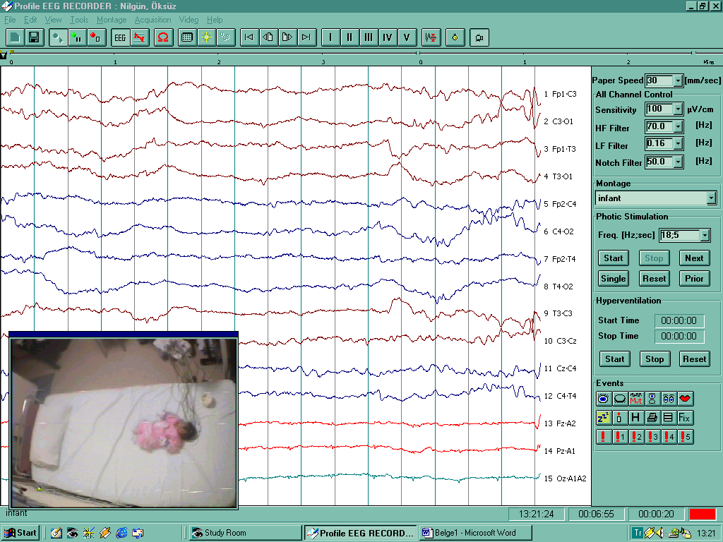Şekil-2: Bilgisayarlı EEG sistemi ile videometrik kayıtların alınması ANALİZ YÖNTEMLERİ EEG Kaydı EEG kayıtları; Profile Mode Digital EEG (Medelec Teca-Wickers Medical, United Kingdom) cihazı