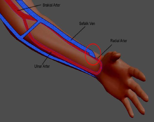 1. Vasküler giriş içindeki Kan Akım Hızı < Kan Pompa Hızı A-V Fistül Fizyolojisi: Oluşan