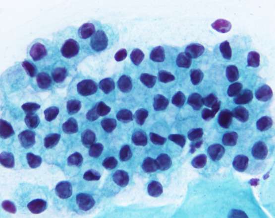 Atipik Endoservikal Hücre Normal Endoservikal Hücre Tubal