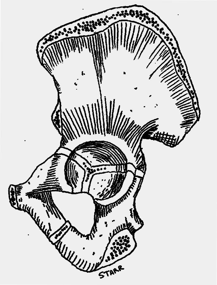 Asetabulum Kırıkları Asetabulum; ilium,