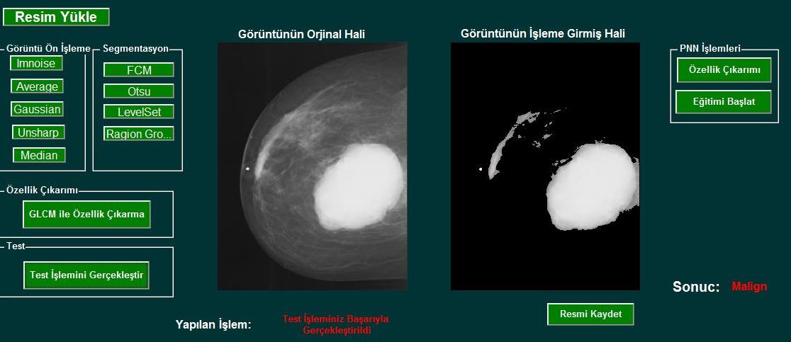 Bölütlenen mamogram görüntülerinin sınıflandırılabilmesi için özellik çıkarım aşamasında GLCM tekniğinden yararlanılmaktadır.
