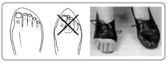 İnspeksiyon Ayakkabılar (deformite, statik, bası yerleri?