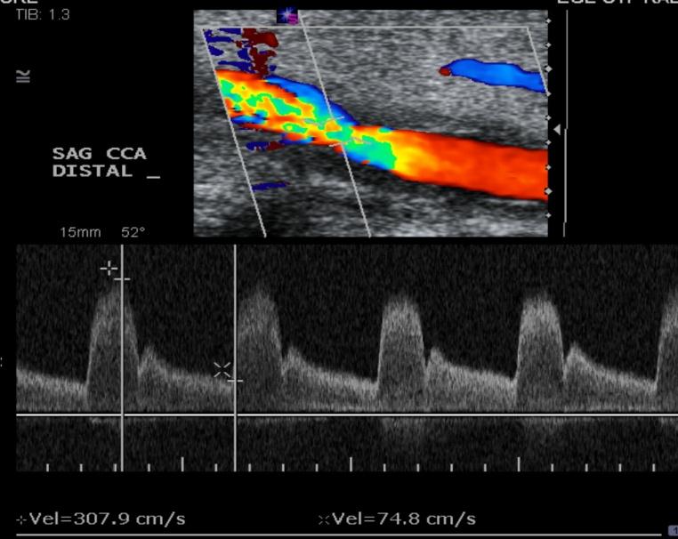 Karotis Arter Doppler US Hemodinamik değerlendirme CCA Stenozu (fokal) Stenoz Kriterleri