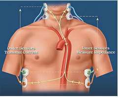 Torasik Elektriksel Biyoempedans Hastaya 20-200 khz düşük akım uygulanır Kalp atımıyla göğüste oluşan empedans ölçülür