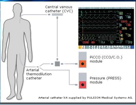 PICCO Az invaziv Pulse counter analizi + termodilüsyon CVP kateteri ile radial veya femoral artere yerleştirilmiş
