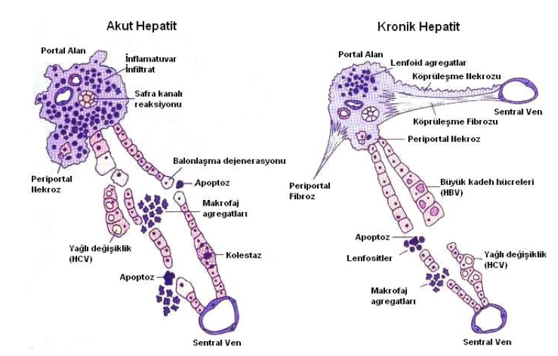 Şekil 2: Akut hepatit ve kronik hepatit histopatolojisi 3.