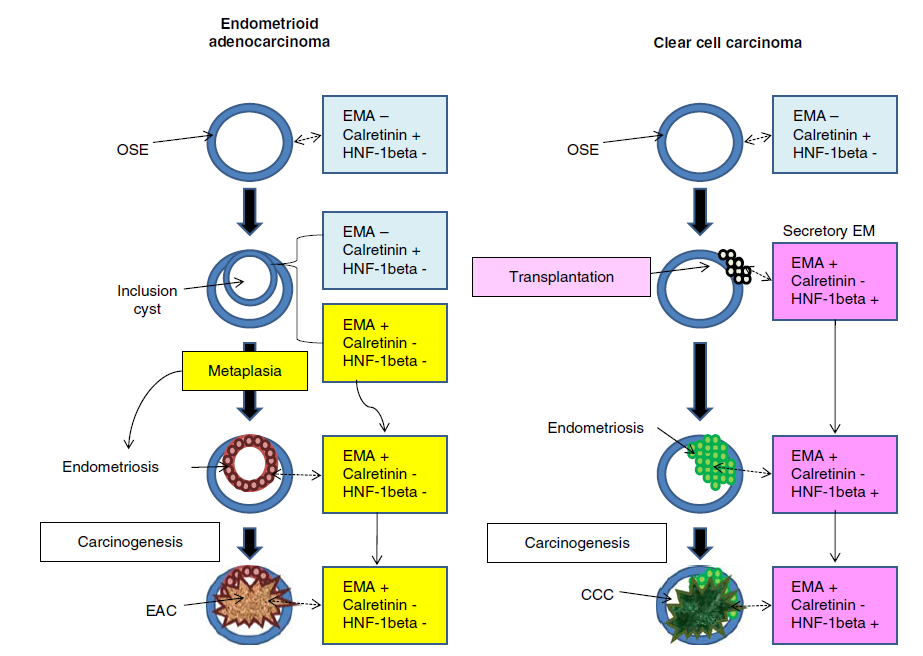 3 Histolojik Kanıtlar Dikotomi EMA: Epiteliel Calretinin: Peritoneal HNF-1: CCC transkripsyon faktörü EMA: