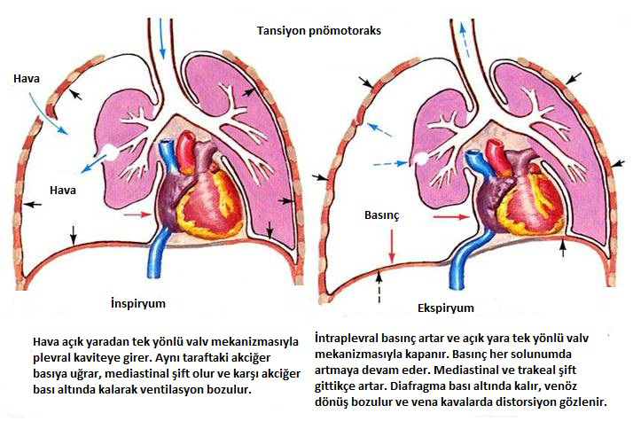 Şekil 3. Tansiyon pnömotoraks fizyopatolojisinin şematik olarak açıklaması atmosferden plevral boşluğa hava emilimine neden olur.