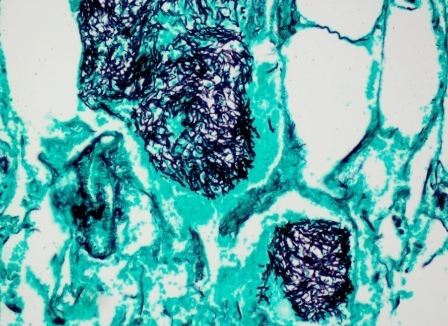 Acremonium Aspergillus H.