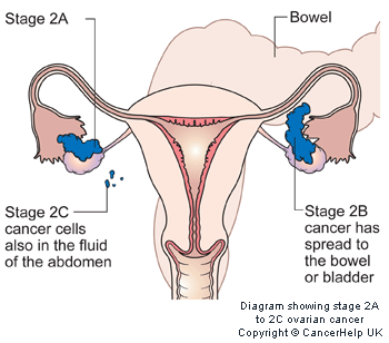 Pelvik yayılım gösteren tek veya her iki overde sınırlı tümör IIA Uterus ve/veya tüplere yayılım gösteren tümör IIB Diğer pelvik organlara yayılım gösteren tümör IIC