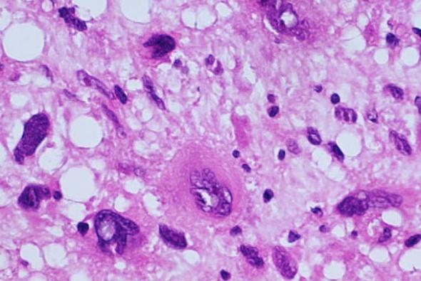 Pleomorfik hyalinize anjiektatik tümör (PHAT) orta yaşlı hasta alt eksteremite, subkutan dokuda iğsi veya pleomorfik hücreler,