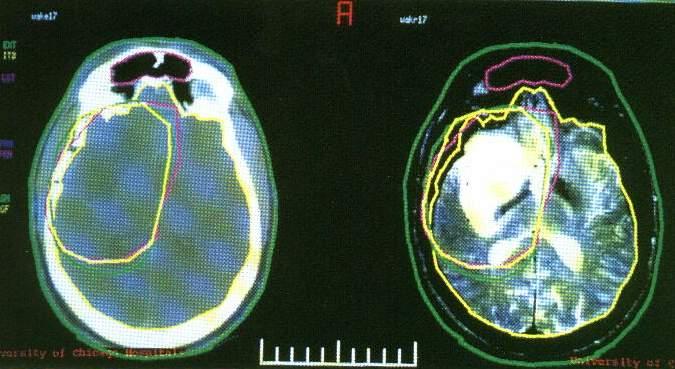 CT+MRI