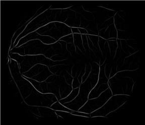 3.3. Damar Bölütleme Retinal kan damarlarının iyileştirildikten sonra siyah-beyaz damar görüntüsünün elde edilmesi gerekmektedir. Bulanık C- ortalama kümeleme yöntemi uygulanmıştır.