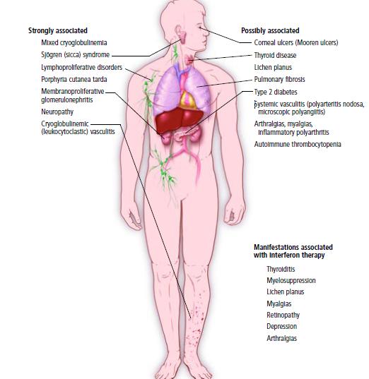 Sıklıkla birliktelik gösterenler Mikst krioglobulinemi Sjögren sendromu Lenfoproliferatif hastalıklar MPGN Nöropati Krioglobulinemik vaskülit Resimler Zayıf birliktelik gösterenler Korneal ülserler