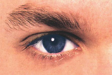 KAYNAK ARKI İnsan sağlığını özellikle gözleri etkileyen bu ışınların tehlikesinden bahsetmek gerekirse: PARLAK IŞINLAR: Gözleri kamaştırır, göz sinirlerinin yorulmasına neden olur.