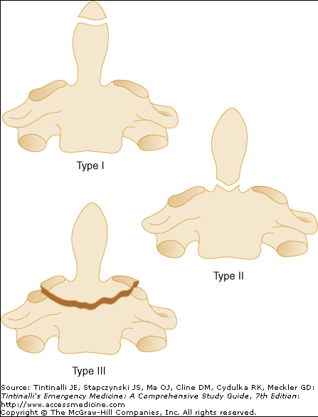 C2 (Odontoid) KIRIKLARI Odontoid kırıklar yaralanmanın derecesine göre sınıflandırılır. Tip 1: Odontoid kemiğin ucunda ayrılma vardır.transvers ligamen kırığı yerinde tutar.