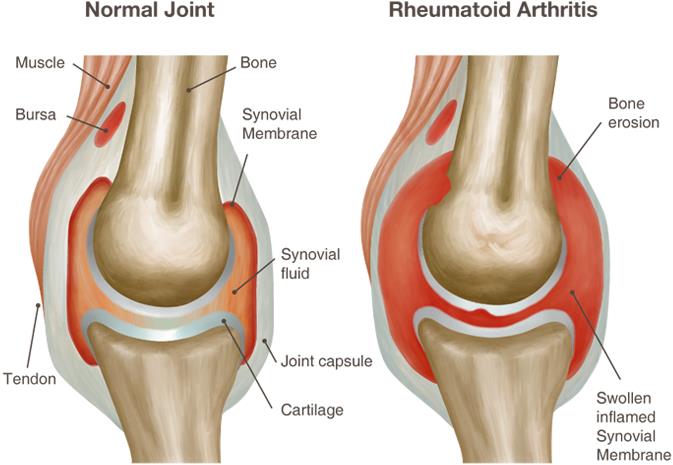 Normal eklem Romatoid artrit li eklem Kas doku Bursae Kemik Synovial membran Kemik