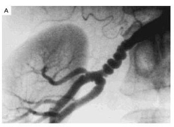 Renal arterin distal kısmı ve dallarını