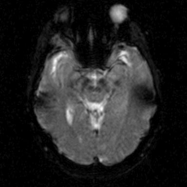 Dynamic Susceptibility Contrast Perfusion MRI Normal