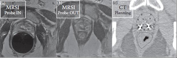 Prob kaynaklı prostat bozulmasını modellemek gereklidir (Şekil 4). FIGURE 4 (See color insert.) (a) Original acquisition image with the suspicious regions delineated.