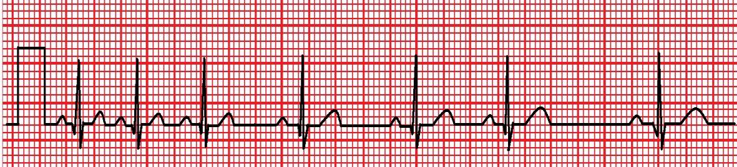sürelik EKG üzerindeki kalp siklusu sayılıp 10 ile çarpılır. Örnek: Şekil 2.9 da EKG üzerinde 6 sn.lik sürede 7 siklus varsa kalp hızı; 7x10=70 atım/dk.dır. Şekil 2.9: Düzensiz ritimli EKG 2.4.