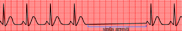 3.1.1.3. Sinüs Bradikardisi Sinüs bradikardisi, dakikada 60 atımın altında olan sinüs ritmidir. Sinüs bradikardisinde EKG özellikleri: Kalp hızı<60 atım/dk.dır. Ritim düzenlidir. 3.1.1.4.