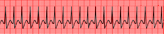 Sinüs arrestinde EKG özellikleri: Kalp siklusları arasında bir duraklama oluşur. Beklenilen yerde P dalgası yerine izoelektrik hat görülür.