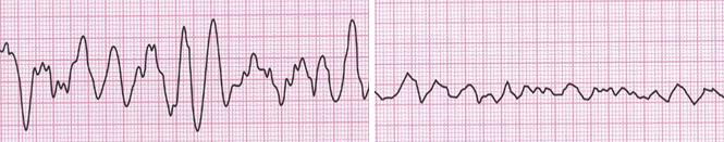 Şekil 3.10: Ventriküler fibrilasyon (VF) Ventriküler fibrilasyonda EKG özellikleri: Kalp hızı belirlenemez. Birbirine benzemeyen anormal, düzensiz dalgalanmalar görülür. Dalgaların hiçbiri izlenemez.