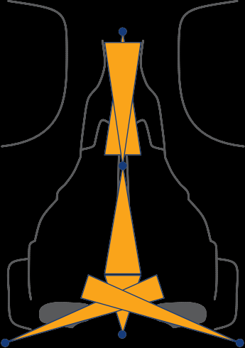 Şekil 2: Anestetik peri-sferik veziküller (mavi noktalar) ve infiltrasyon paternleri (turuncu üçgenler).