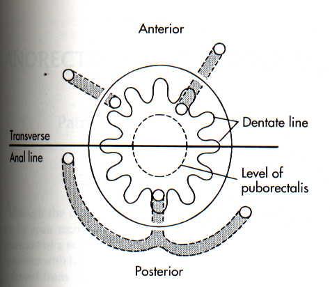 Şekil 6a: Goodsall - Sallmon kuralı (The ASCRS text book of colon and rectum surgery) Goodsall kuralı : Perineden transvers bir çizgi çizildiğinde dış ağız posterior yerleşimliyse iç ağız posterior