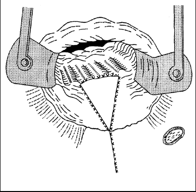 Anokutanöz ilerletme flebi: Delino ve ark. tarafından tanımlanmıştır (61). İç deliği kapatmak için rektum mukazası yerine anal marjın derisi kullanılır.