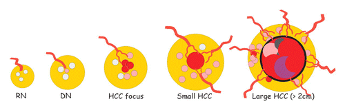 Hastalıklı karaciğer parenkiminde gelişen fokal hepatik lezyonlar T1A İzo izo hiper Hipo hipo T2A İzo izo İzo Hiper hiper AF izo izo