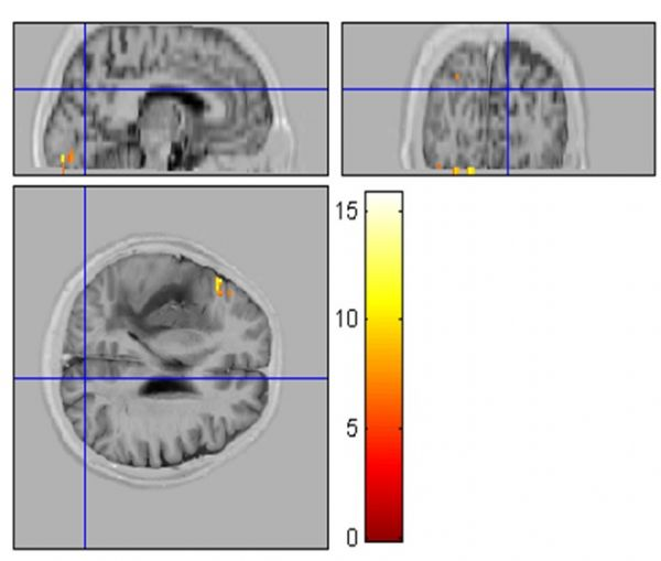 Figür 5 FSL sonuçlarında alanı ve görsel korteks aktivasyonları www.
