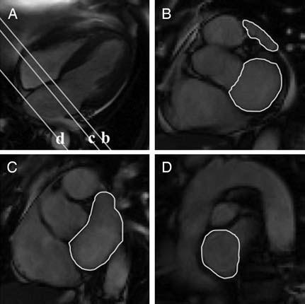 MRI ve STEMI sonrasında MACE LA fraksiyonel değişim bağımsız belirleyici Lonborg L,et al.